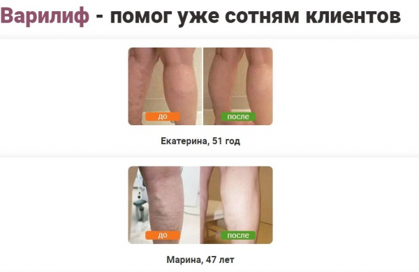 Варилиф для ног Варилиф для ног