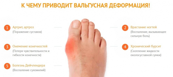
Вальгукорр при вальгусной деформации 