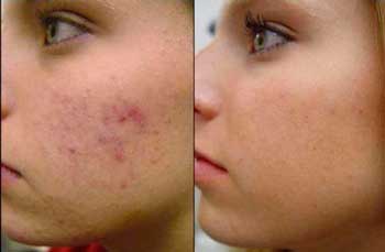 Крем Intraskin
Крем Intraskin