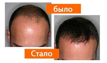 Profolan для волос
Profolan для волос
