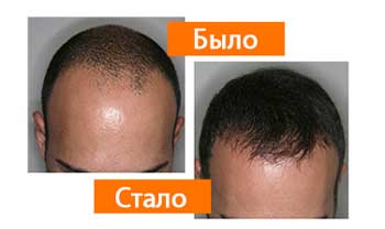Profolan для волос
Profolan для волос