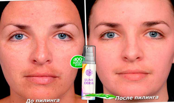 
Пилинг LUMIDERM 
