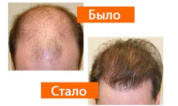 Profolan для волос
Profolan для волос
