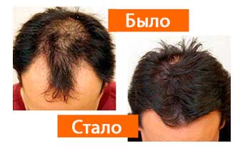 Profolan для волос
Profolan для волос