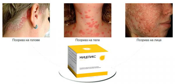 Мицеликс от псориаза
Мицеликс от псориаза