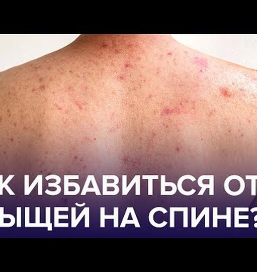 Что делать, если появились прыщи на плечах и спине? Что делать, если появились прыщи на плечах и спине?