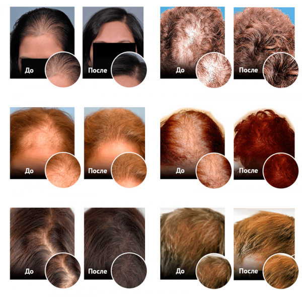 Perfect Hair для волос
Perfect Hair для волос