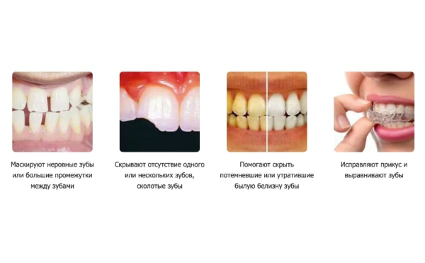Crystal Veneers
Crystal Veneers