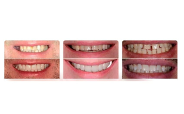 Crystal Veneers
Crystal Veneers
