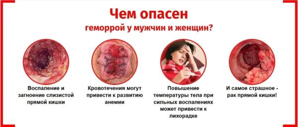 Hemora — крем от геморроя
Hemora — крем от геморроя